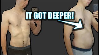 Pectus Excavatum Surgery Sams Story [upl. by Kronfeld]