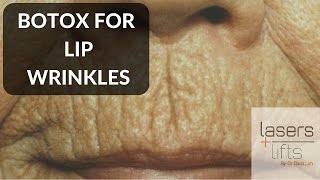 BOTOX for lip wrinkles [upl. by Kcerb]