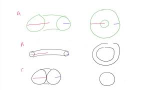 What is a multifocal toric intraocular lens IOL [upl. by Lorelie]