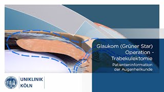 Glaukom Grüner Star OP  Trabekulektomie Patienteninformation Augenklinik  Uniklinik Köln [upl. by Walkling98]