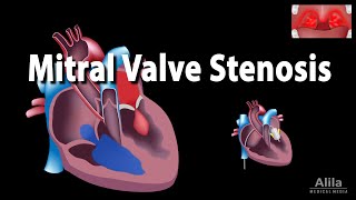 Mitral Valve Stenosis Diagnosis Treatment Pathophysiology [upl. by Aineval]