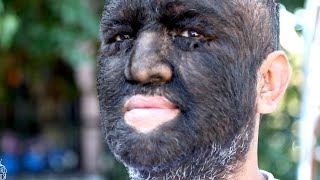 Meet the Worlds Hairiest Man [upl. by Hutton]