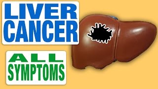 Liver Cancer  All Symptoms [upl. by Arahsak779]