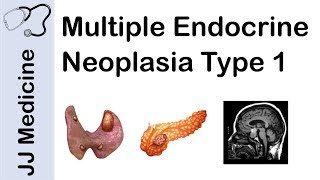 Multiple Endocrine Neoplasia Type 1 MEN1  Signs and Symptoms Diagnosis and Treatment [upl. by Sirrad930]