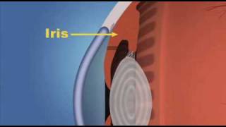 Iridotomy [upl. by Aik]