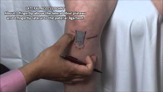 Knee Injection  Anterior Approach [upl. by Schiffman770]