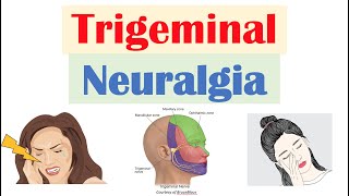 Genicular Neurotomy Ablation RFA of the Knee [upl. by Petras]