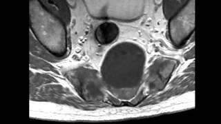 Sacral Chordoma [upl. by Eniluqaj]