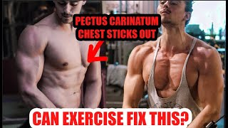 FIX PECTUS EXCAVATUM THROUGH BODYBUILDING [upl. by Samford]