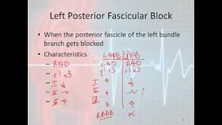 Left Anterior Fascicular Block  How to Read an Electrocardiogram EKG  MEDZCOOL [upl. by Airda]