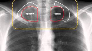 Turner Syndrome 101 [upl. by Isbel]