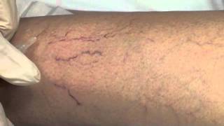 Spider Vein Sclerotherapy [upl. by Ihcur680]