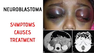 NEUROBLASTOMA Symptoms Signs Causes Treatment [upl. by Luapsemaj]