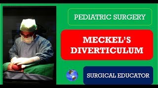 MECKELS DIVERTICULUM How To DIAGNOSE amp TREAT Pediatric Surgery [upl. by Weeks]