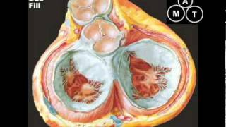 MitraClip  Mitral Valve Repair [upl. by Cathi]