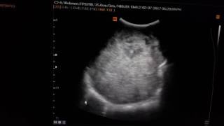 Neuroblastoma Sonography [upl. by Anitra]