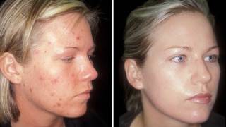 HOW TO CURE ACNE  CLEAR SKIN IN ONE WEEK [upl. by Gareri]