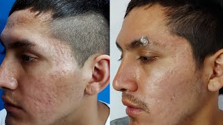 🔥 El MEJOR TRATAMIENTO para CICATRICES DE ACNE y otras 2021✅ DERMAPEN  SUBCISION  ANTES Y DESPUES [upl. by Hess577]