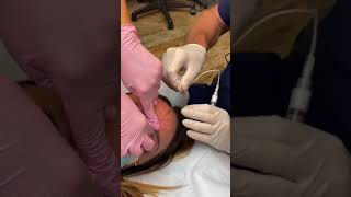 Treating Bulging Forehead Veins [upl. by Ellimaj262]