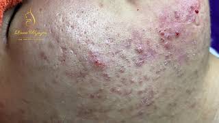 Blackheads Removal 333a  Loan Nguyen [upl. by Atlanta]