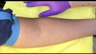 Tips For Locating Difficult Veins [upl. by Onfroi]