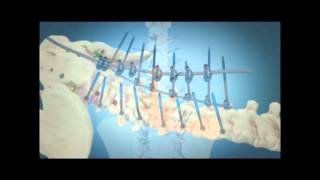 Scoliosis Surgical Correction with Instrumentation [upl. by Tamas830]